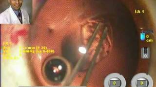 AcrySof Toric IOL Implantation in Anterior Lenticonus in a 15 yr Child Dr Suresh Pandey Suvi Kota [upl. by Anivahs975]