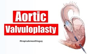 Heart Valve Replacement Options [upl. by Kenon]