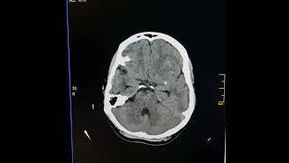 Cyst of cavum septum pellucidum causing mild obstructive hydrocephalus [upl. by Nordgren]