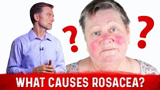 Dr Berg’s Opinion on Causes of Rosacea and Its Treatment [upl. by Ailama]