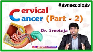 Cervical Cancer part 2  Obstetrics and gynaecology Video lectures  Medvizz app [upl. by Ahsemot818]