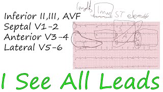 How To Read ECG Step By Step Part 3 of 3 12 lead interpretation [upl. by Eleik224]