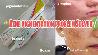 Get Rid Of Acne Pimples Hyperpigmentation  Supatret C Aqueous gel  Tretinoin Cream [upl. by Thamora]