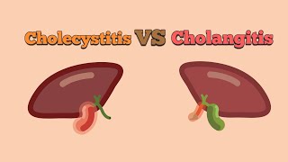 Difference between Cholangitis and Cholecytitis [upl. by Loginov]