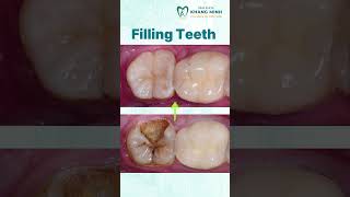 Filling Teeth shorts teeth dentist [upl. by Birk882]