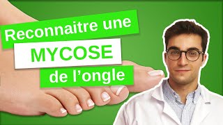 Savoir RECONNAÎTRE une MYCOSE de longle  Onychomycose 13 [upl. by Charie550]