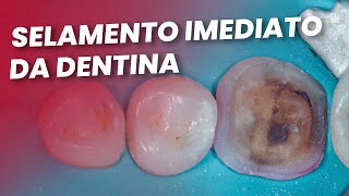 SELAMENTO IMEDIATO DA DENTINA  Mylene e Renato [upl. by Wertz]