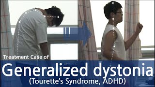 Generalized dystonia  Tourette’s Syndrome  Cervical dystonia  tic disorder  전신사경증 [upl. by Htaeh588]