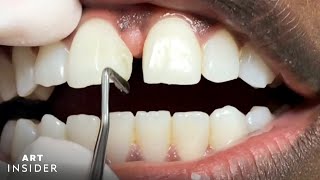 How Tooth Gaps Are Filled  Insider Art [upl. by Mikeb]