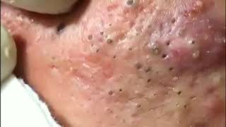 Best Blackhead Removal Ever 2020 [upl. by Aisylla679]