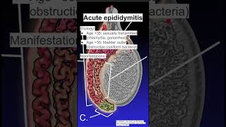 Acute epididymitis [upl. by Dola]