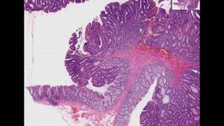 Histopathology Colon Tubular adenoma adenomatous polyp [upl. by Letniuq]