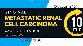 Metastatic Renal cell carcinomaOralpathology360 [upl. by Iruam739]