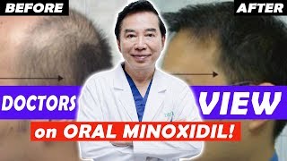 Doctor Reviews Oral Minoxidil for Hair Loss Shares Before and After Result  Episode 3 [upl. by Nolos]