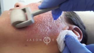 Dermaroller  Microneedling Acne Scars  Skin Resurfacing  Los Angeles California [upl. by Aiuqes]