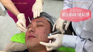 Rudy Lim  Rejuran and laser for Acne Scars  Centre for cosmetic [upl. by Trinidad]