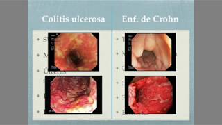 Episodio 1730 Apaga El Fuego Del Colon Irritable [upl. by Shaun533]