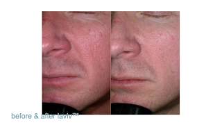 FDAApproved LaViv Fibroblast Treatment  Maryland Laser Skin amp Vein [upl. by Yemrej]