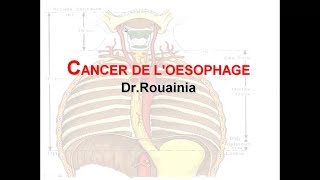 Canser de loesophage  Dr Rouainia [upl. by Ycul]