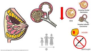 Breast Disease  Risk Lesions Pt 2  DCIS [upl. by Anaig724]