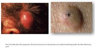 Sebaceous Cysts Causes Symptoms and How to Treat Them [upl. by Undis]