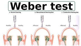 Weber test [upl. by Ojyma]