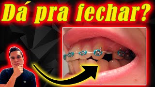 É POSSÍVEL FECHAR O ESPAÇO DE DENTE EXTRAÍDO COM APARELHO ORTODÔNTICO  REVELEI DEFINITIVAMENTE [upl. by Westfahl]