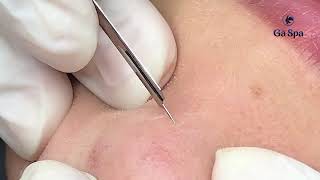 The Service in Our Spa Blackhead amp Hidden Acne Removal [upl. by Devi]