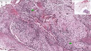 Osteosarcoma  Histopathology [upl. by Munt899]