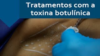 TRATAMENTO COM A TOXINA BOTULÍNICA E SUAS VANTAGENS [upl. by Chappelka]