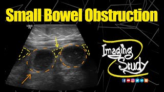 Small Bowel Obstruction  Ultrasound  Case 152 [upl. by Linders]