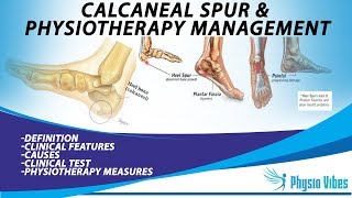 CALCANEAL SPUR amp PHYSIOTHERAPY MANAGEMENT [upl. by Fiedling37]