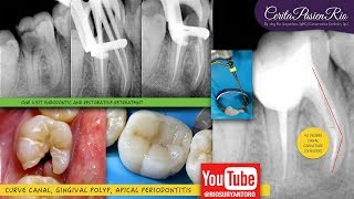 One curve micromega visit endodontic treatment gingival hyperplastic polyp electrosurgery [upl. by London]