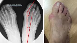 ¿Qué son los Juanetes o Hallux Valgus y Cómo se Tratan [upl. by Dnilasor]