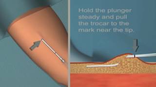 Jadelle insertion and removal Tutorial [upl. by Enimrac161]