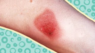 How to Treat Cellulitis [upl. by Adala10]