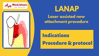 LANAP Laser assisted New Attachment procedure l Periodontal Regeneration l Mediklaas [upl. by Hsiekal]