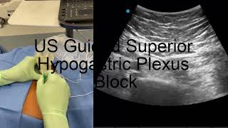 Ultrasound Guided Superior Hypogastric Plexus Block [upl. by Cassy]