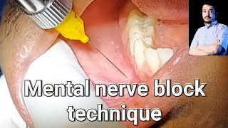 Local Anesthesia Mental Nerve block technique mandibular anesthesia Techniques dentistry [upl. by Schonthal275]