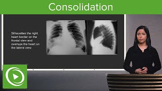 Consolidation – Radiology  Lecturio [upl. by Jenne]