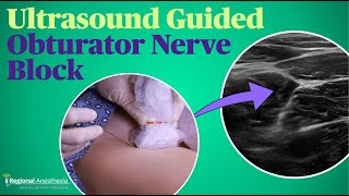 Ultrasound Guided Obturator Nerve Block [upl. by Anoblav]