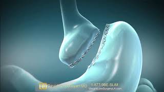 Gastric Bypass Bariatric Surgery Animation [upl. by Nollie]