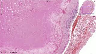 Branchial Cleft Cyst  Histopathology [upl. by Asira]