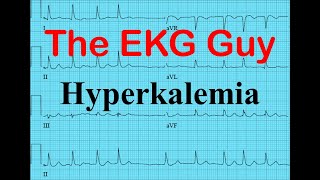 EKGECG  Hyperkalemia  The EKG Guy  wwwekgmd [upl. by Hershel]