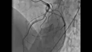 Normal Coronary angiogram 653 2018 [upl. by Mandler]