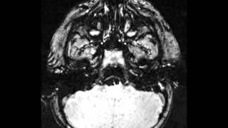 CocaineInduced Coronary Artery Vasospasm [upl. by Elletnwahs266]