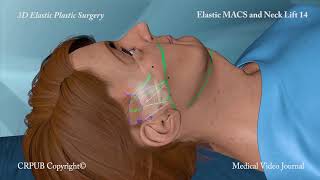 3D MACS and Neck Lift [upl. by Nya]