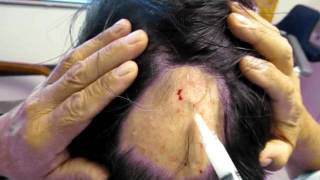 alopecia areata injections [upl. by Hayton]