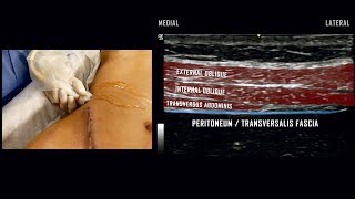 Transversus Abdominis Plane TAP Block  UltrasoundGuided Demonstration [upl. by Lothair]