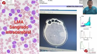 LEUCEMIA AGUDA con sangrado intracerebral Atención a los datos clínicos de alarma [upl. by Olen]